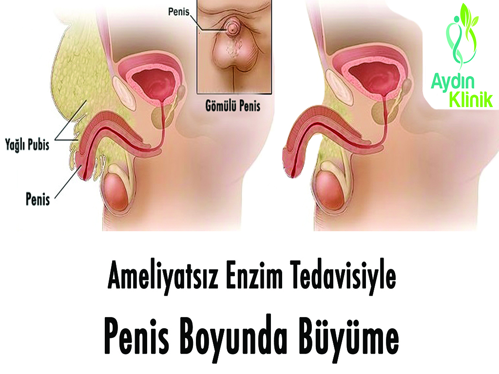 Penis Buyutme